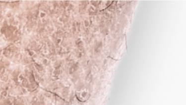 Ichtyose