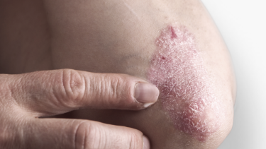 Pathologie Psoriasis