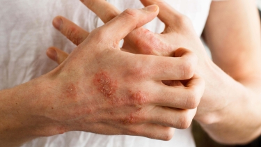 illustration eczema